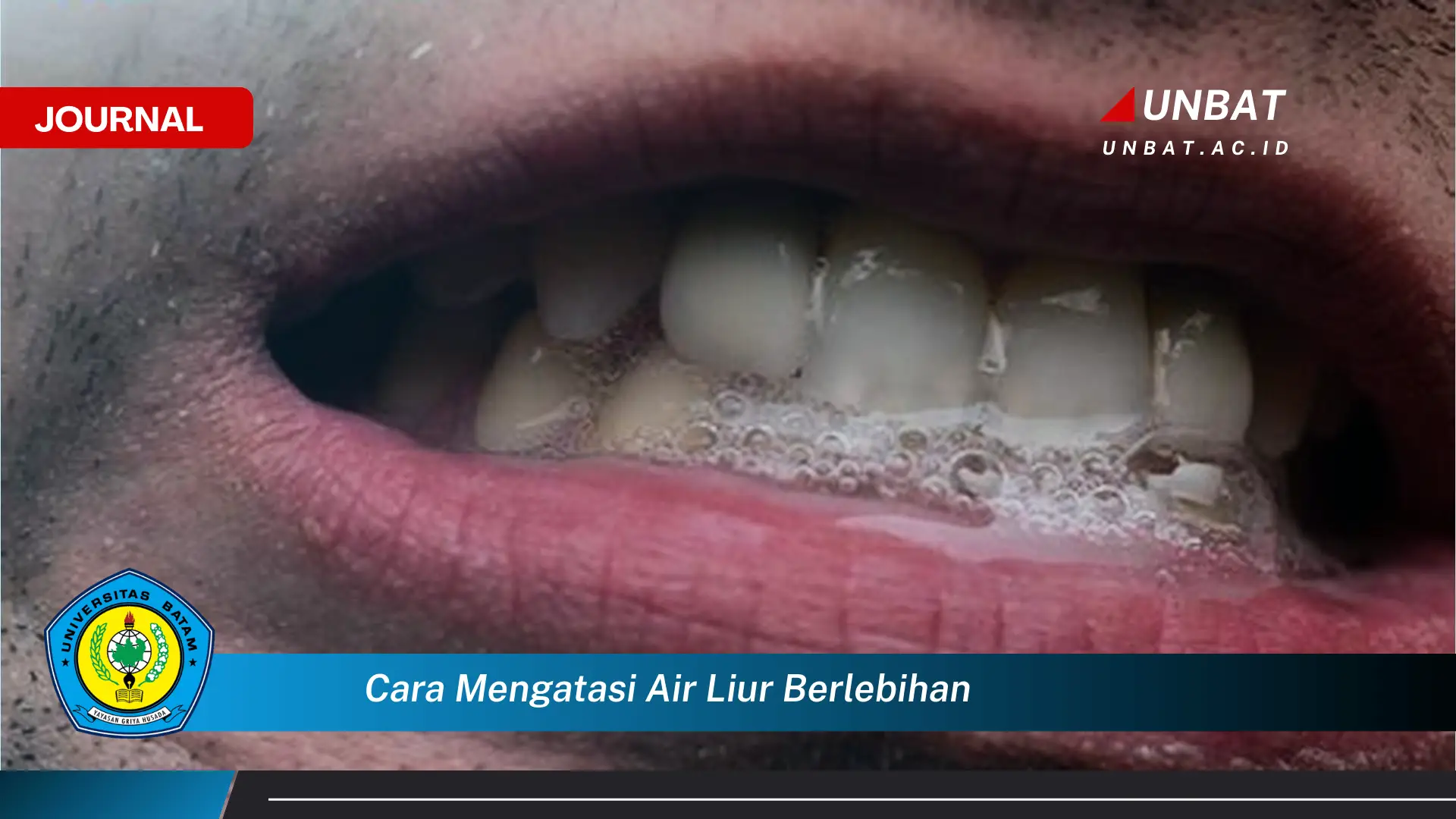 Inilah Cara Mengatasi Air Liur Berlebihan dan Penyebabnya