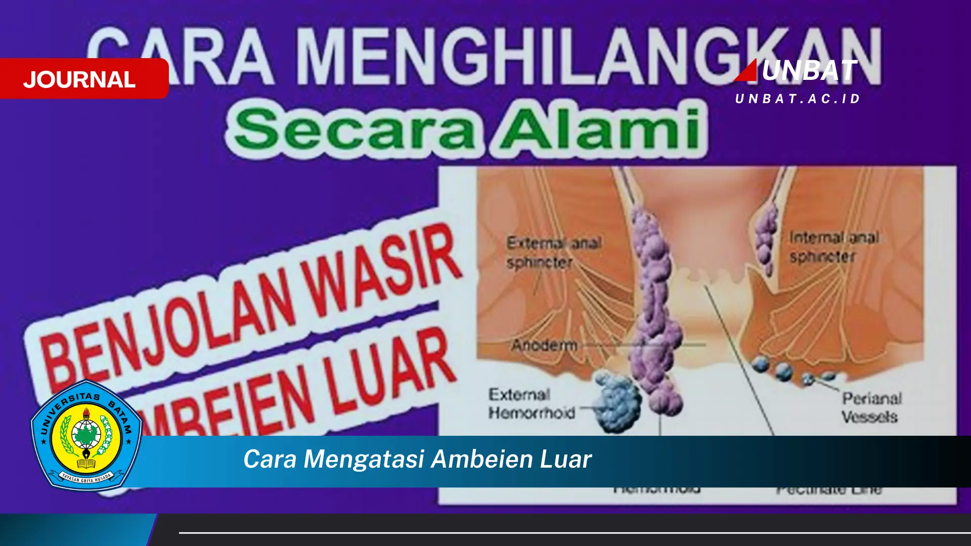 Ketahui Cara Mengatasi Ambeien Luar Dengan Cepat dan Alami