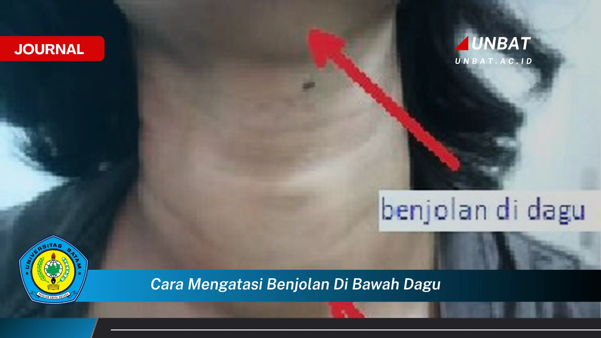 Ketahui Cara Mengatasi Benjolan di Bawah Dagu Secara Efektif dan Aman