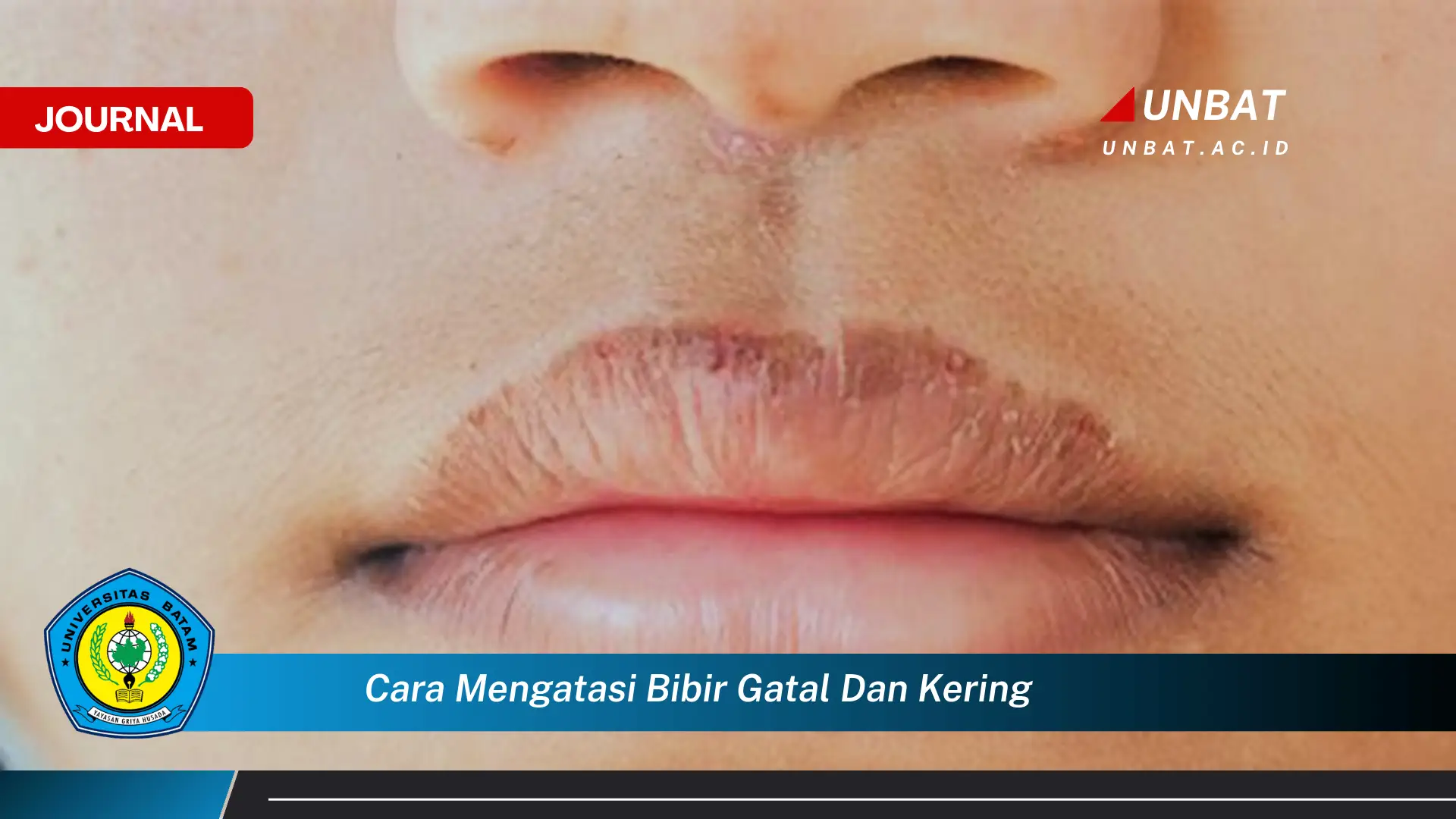 Ketahui Cara Mengatasi Bibir Gatal dan Kering Secara Alami dan Efektif