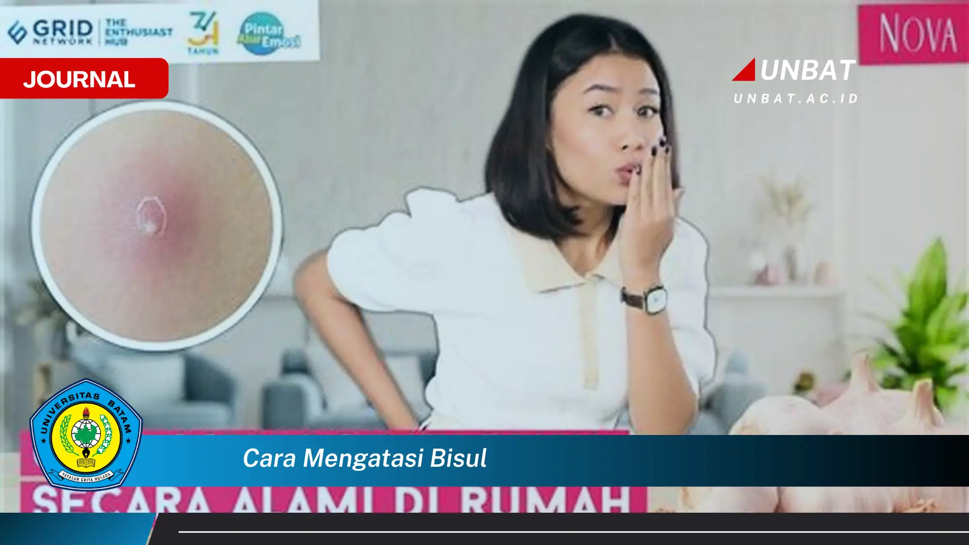 Ketahui Cara Mengatasi Bisul dengan Cepat dan Aman Ketahui Cara Mengatasi Bisul dengan Cepat dan Aman