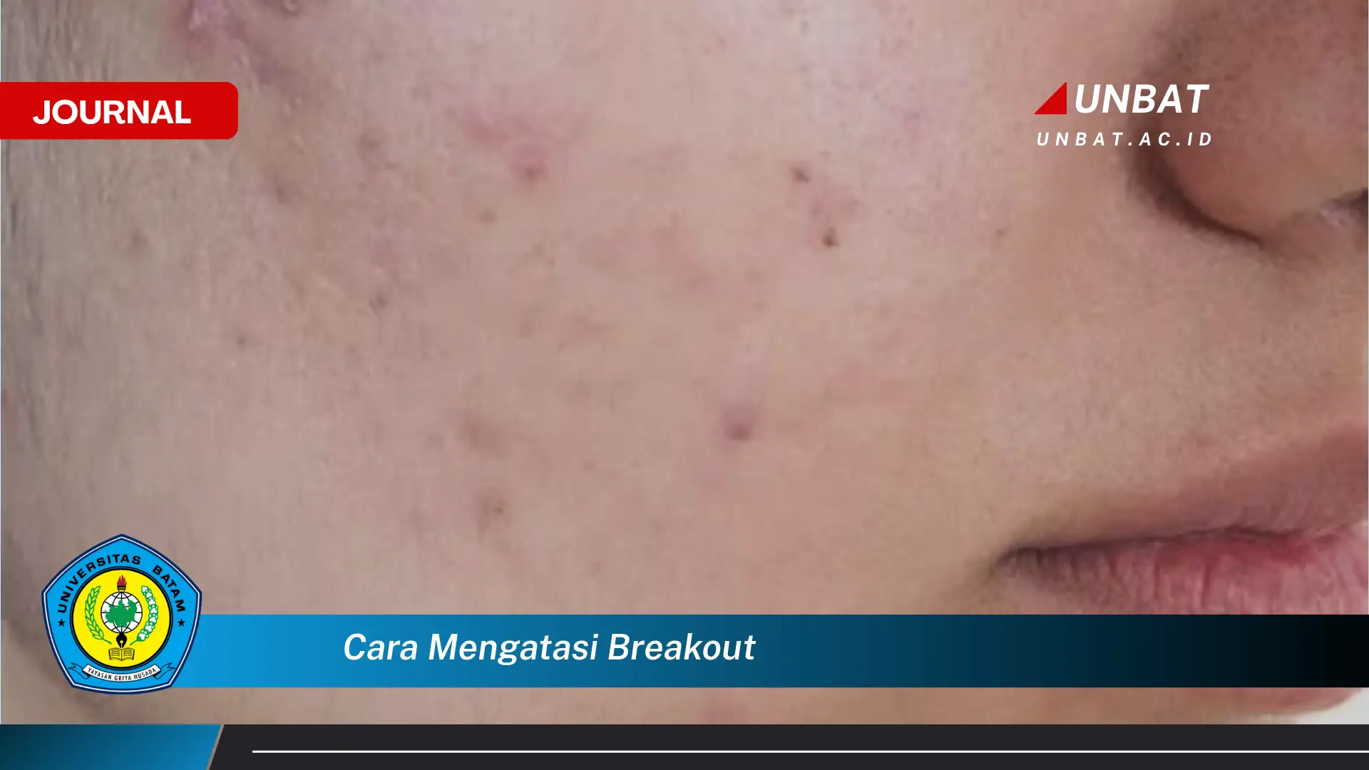 Ketahui Cara Mengatasi Breakout dengan Cepat dan Ampuh