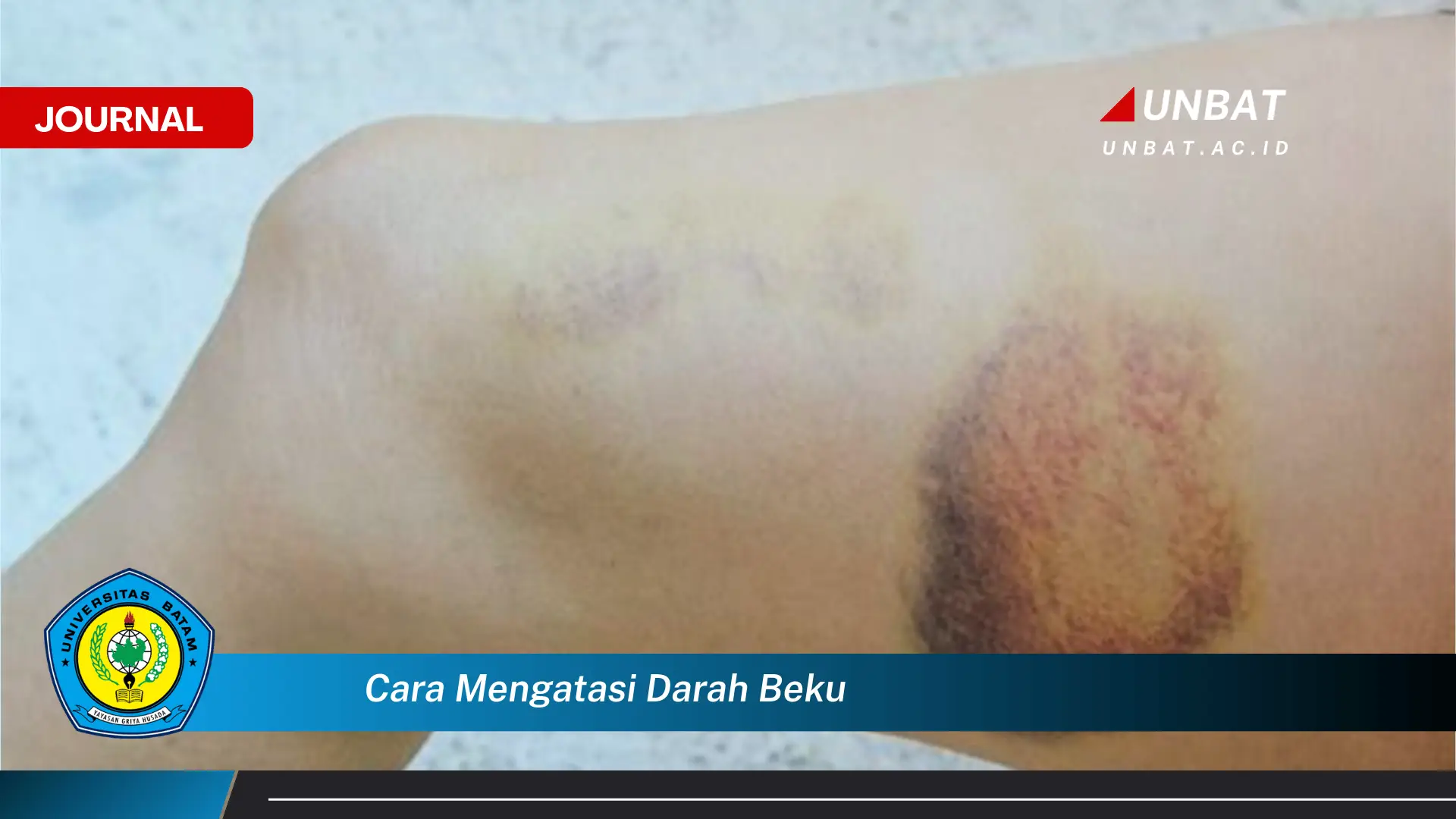 Ketahui Cara Mencegah dan Mengatasi Darah Beku Secara Efektif