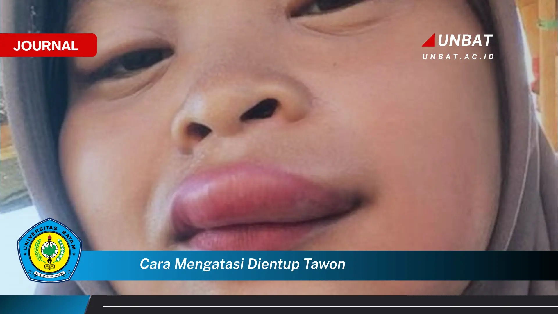 Ketahui Cara Mengatasi Sengatan Tawon, Pertolongan Pertama yang Cepat dan Efektif Ketahui Cara Mengatasi Sengatan Tawon, Pertolongan Pertama yang Cepat dan Efektif
