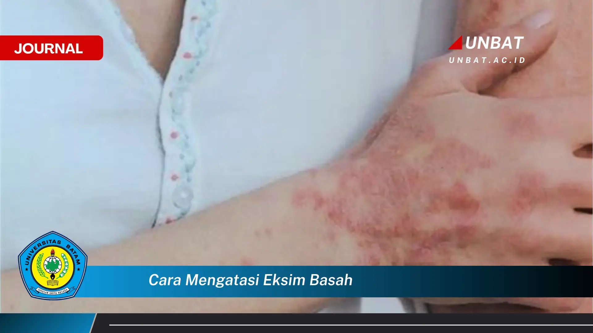 Inilah Cara Mengatasi Eksim Basah Secara Alami dan Efektif