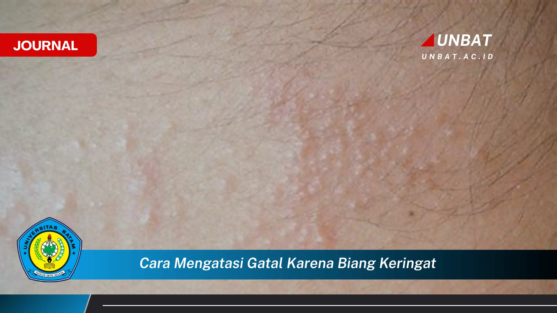 Ketahui Cara Mengatasi Gatal Karena Biang Keringat Secara Efektif dan Alami