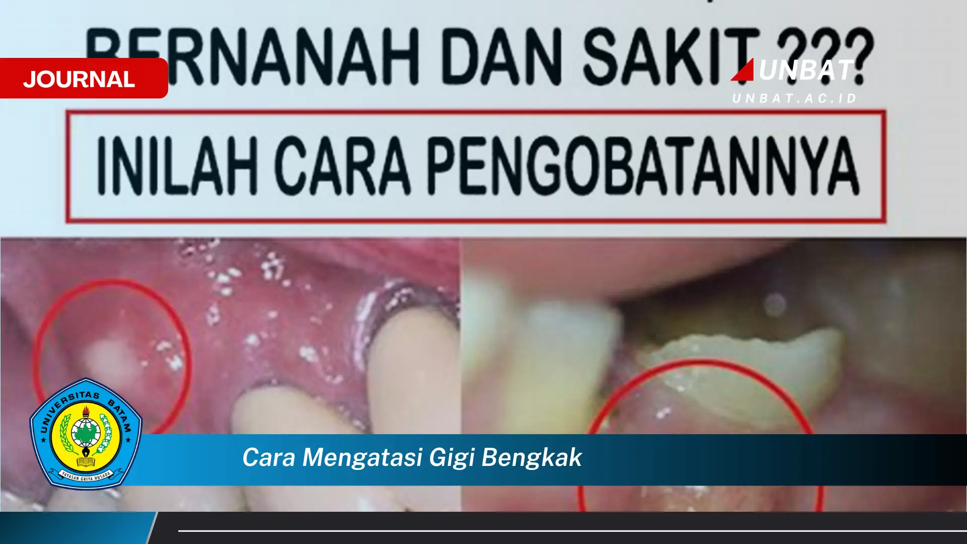 Ketahui Cara Mengatasi Gigi Bengkak dengan Cepat dan Ampuh