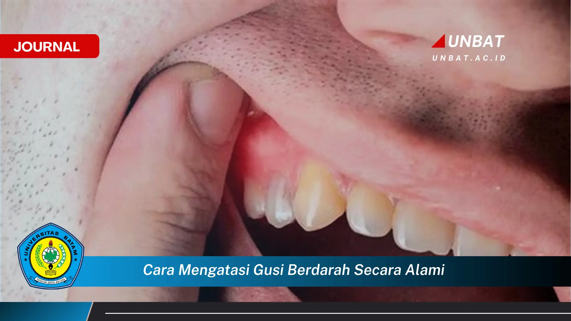 Inilah Cara Mengatasi Gusi Berdarah Secara Alami, 7 Langkah Ampuh di Rumah