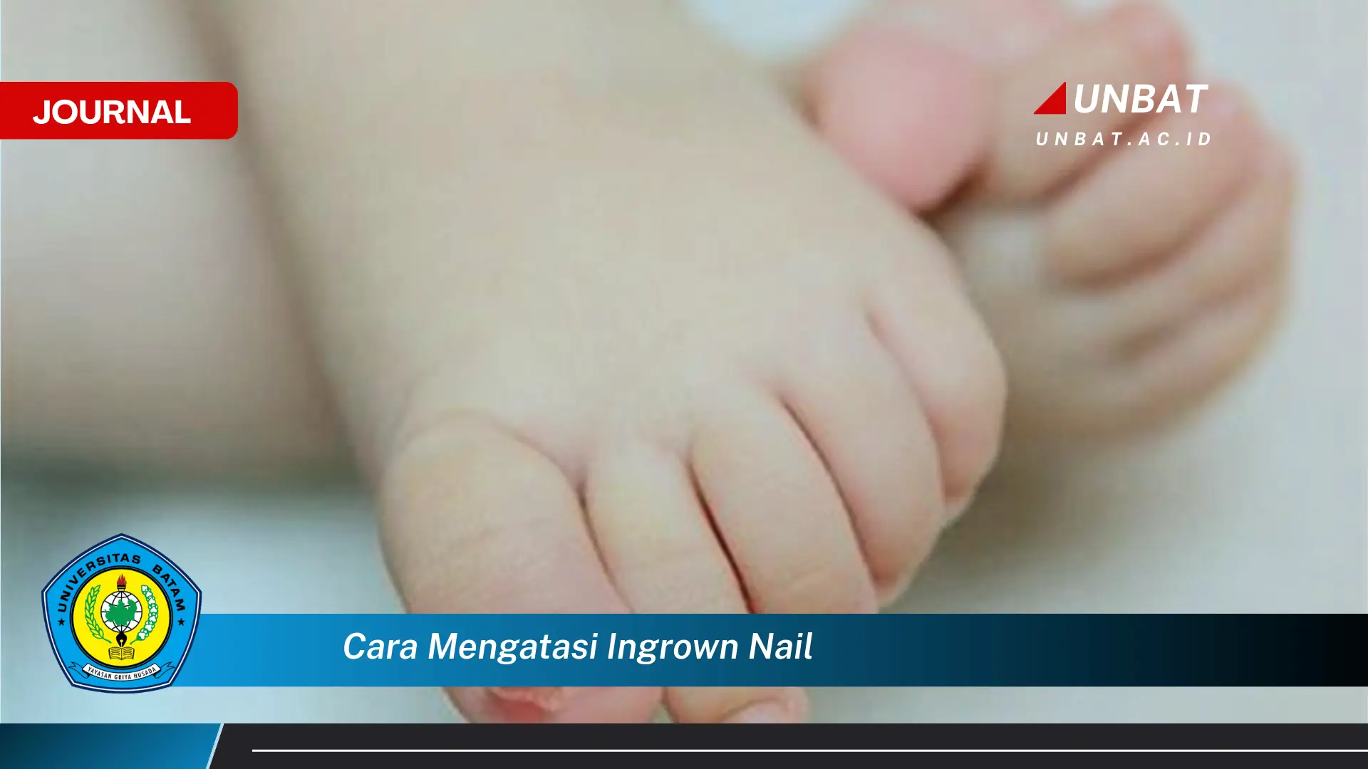 Ketahui Cara Mengatasi Ingrown Nail Secara Efektif dan Aman di Rumah