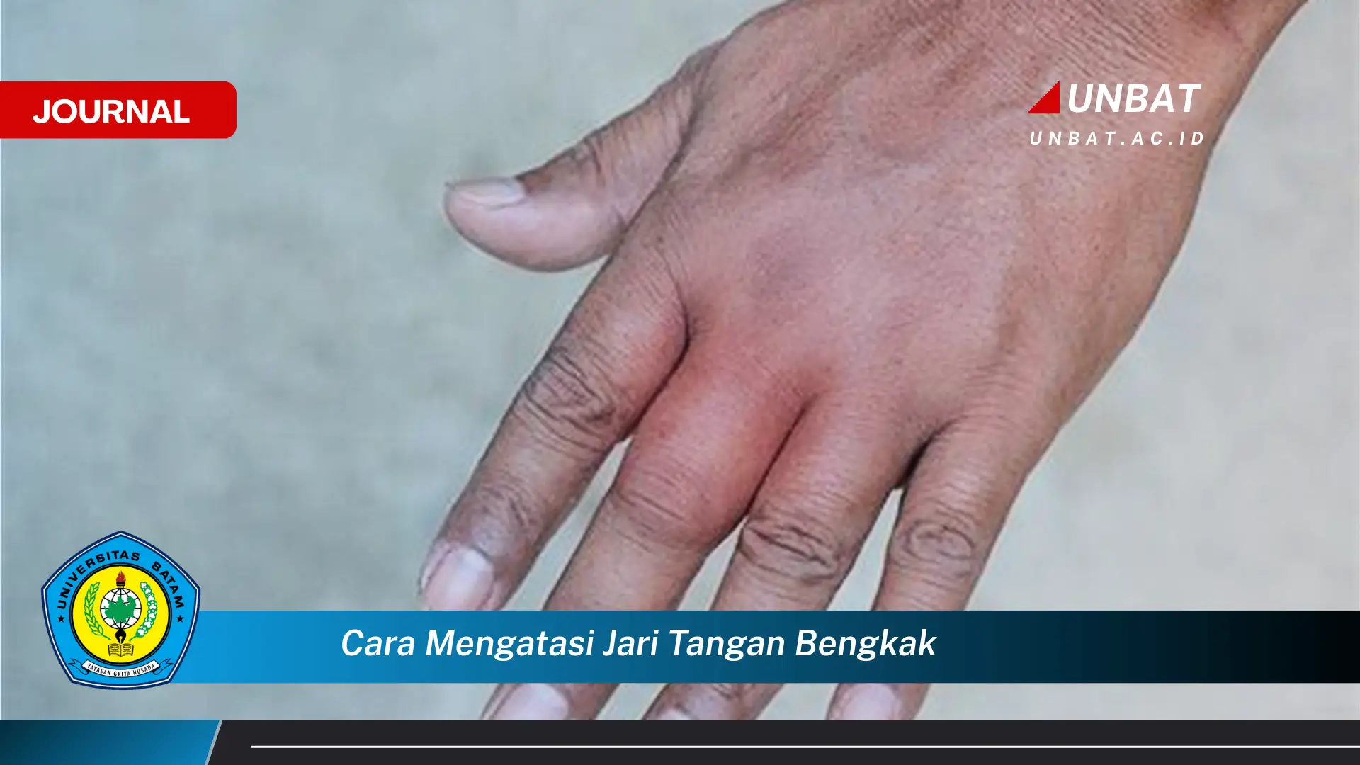 Ketahui Cara Mengatasi Jari Tangan Bengkak dengan Cepat dan Efektif Ketahui Cara Mengatasi Jari Tangan Bengkak dengan Cepat dan Efektif