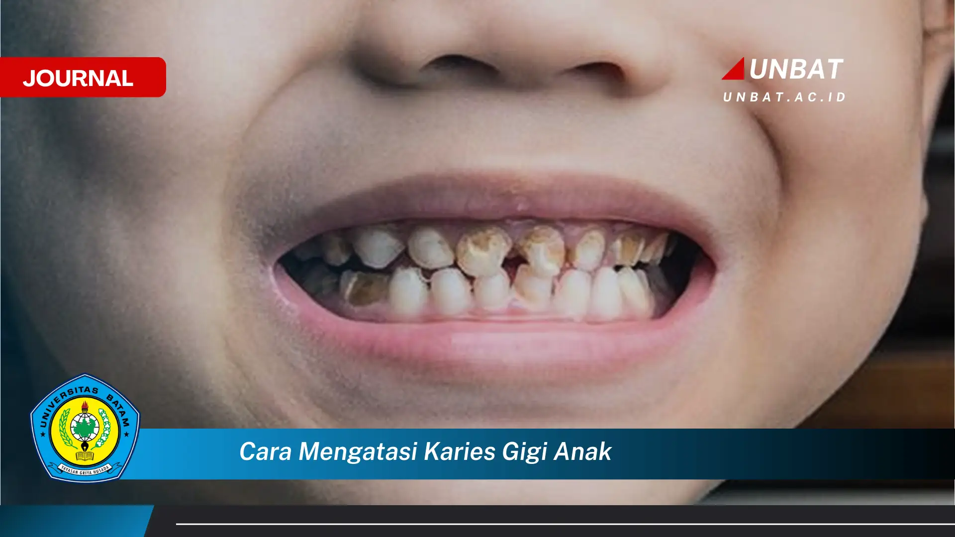 Ketahui Cara Mencegah dan Mengatasi Karies Gigi Anak Sejak Dini