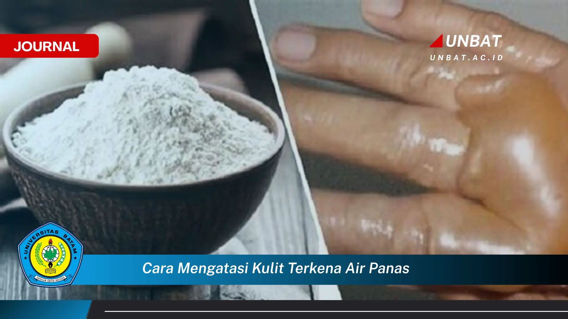 Ketahui Cara Mengatasi Kulit Terkena Air Panas dengan Cepat dan Efektif Ketahui Cara Mengatasi Kulit Terkena Air Panas dengan Cepat dan Efektif