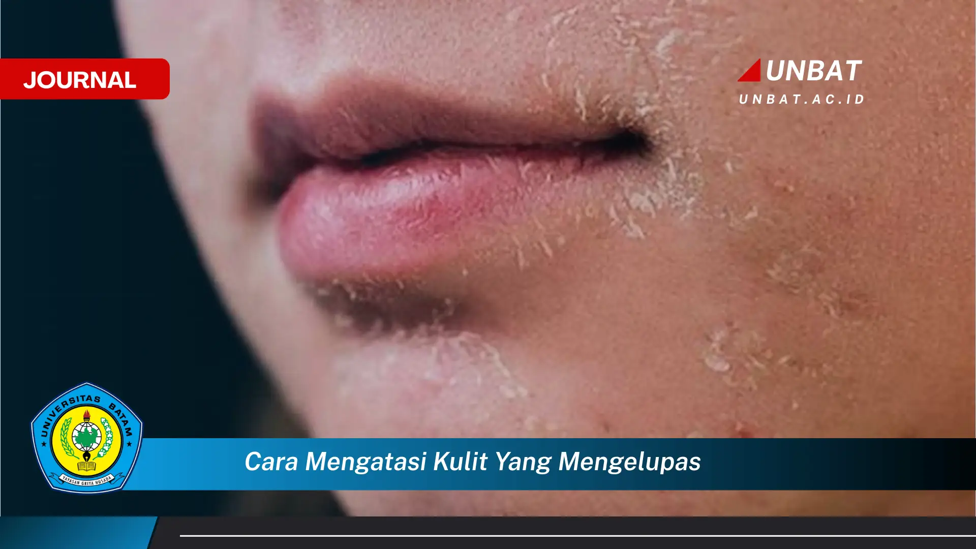 Ketahui Cara Mengatasi Kulit yang Mengelupas, Penyebab dan Solusinya Ketahui Cara Mengatasi Kulit yang Mengelupas, Penyebab dan Solusinya