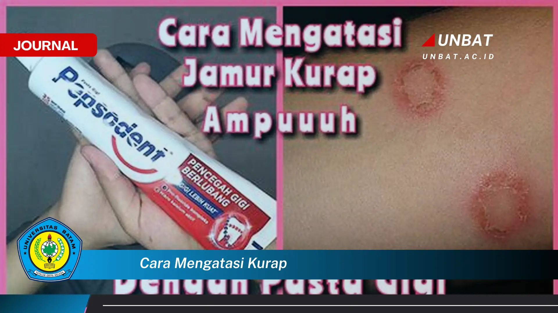 Ketahui Cara Mengatasi Kurap dengan Cepat dan Ampuh