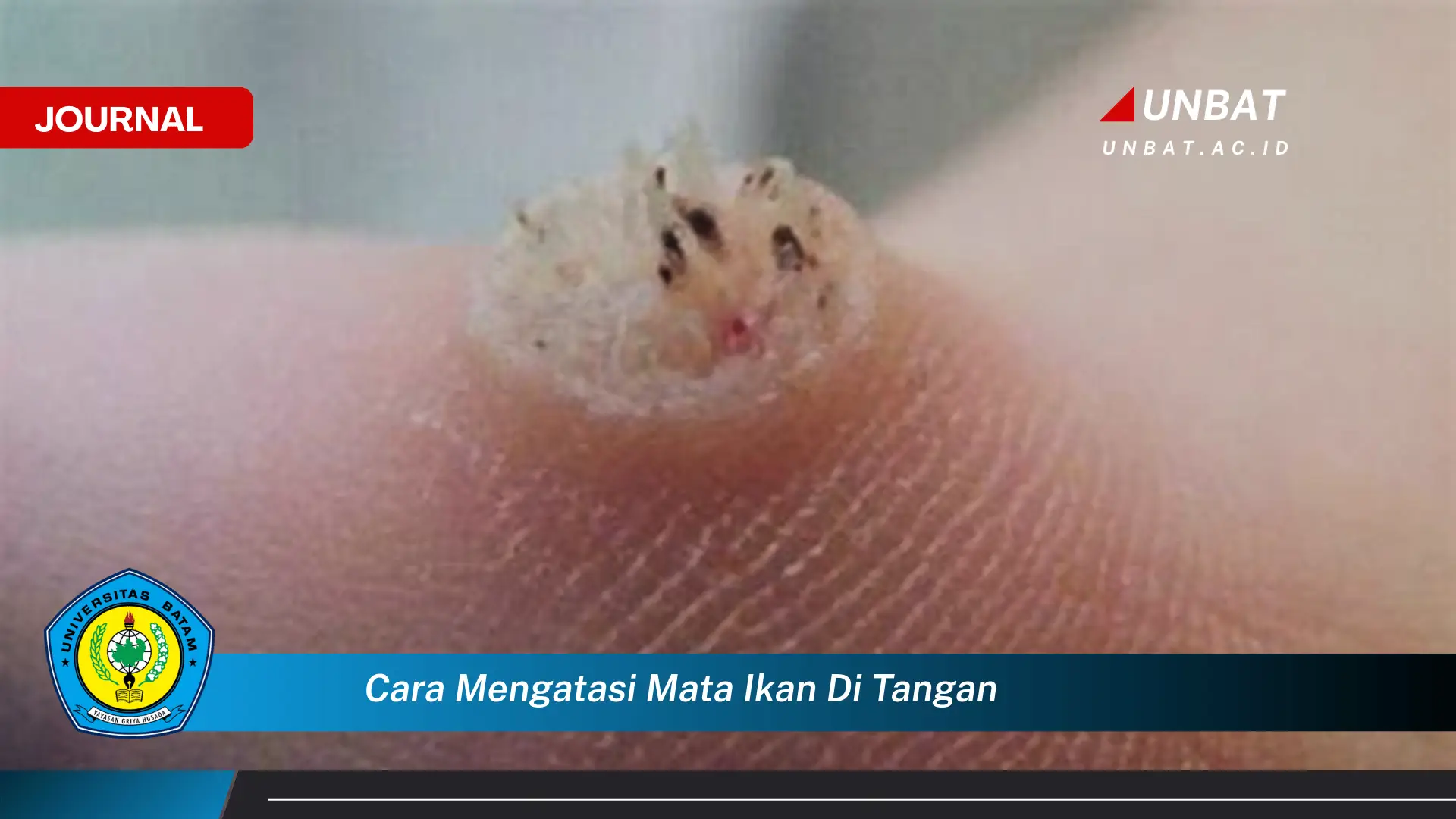 Ketahui Cara Mengatasi Mata Ikan di Tangan dengan Ampuh dan Efektif