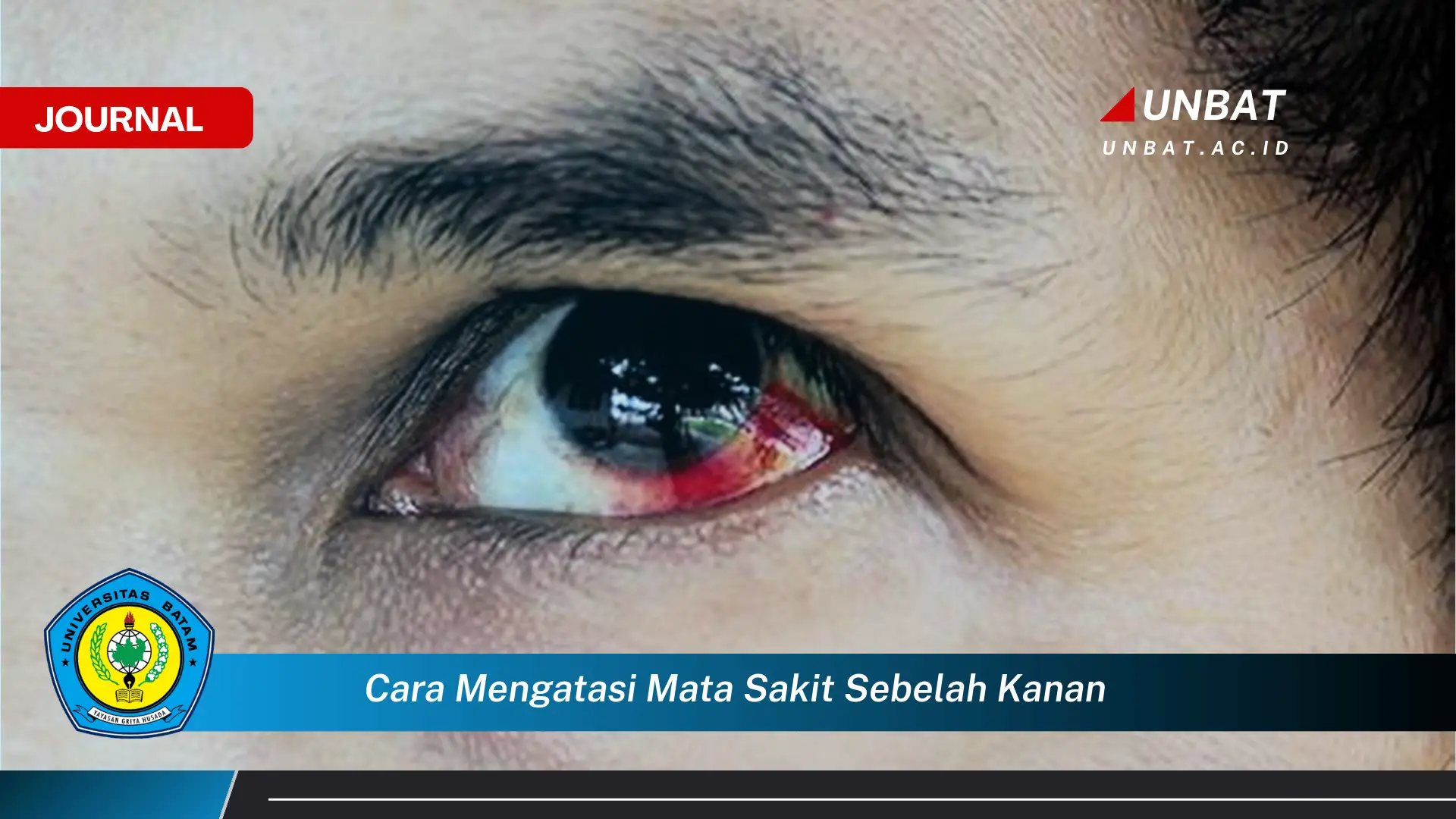 Ketahui Cara Mengatasi Mata Sakit Sebelah Kanan dengan Cepat dan Aman Ketahui Cara Mengatasi Mata Sakit Sebelah Kanan dengan Cepat dan Aman
