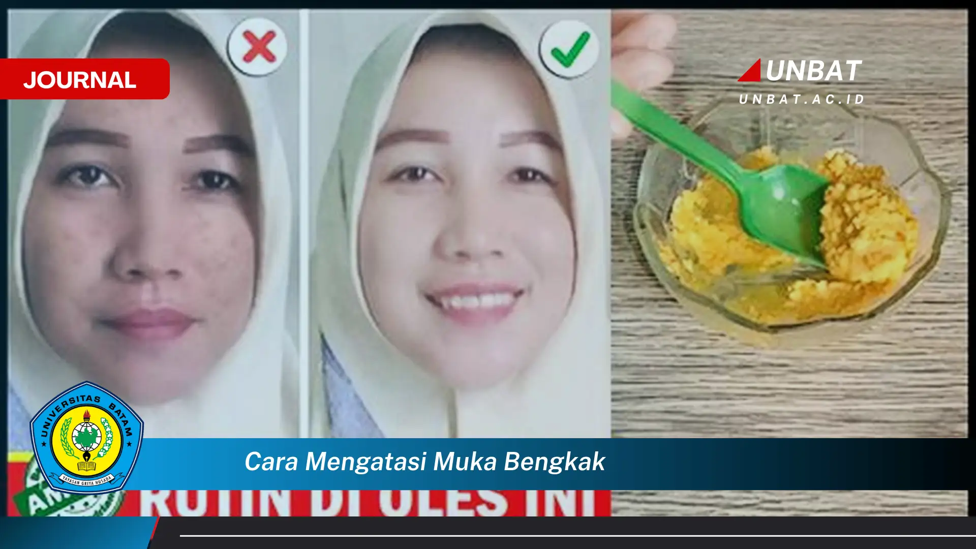 Ketahui Cara Mengatasi Muka Bengkak Secara Cepat dan Alami Ketahui Cara Mengatasi Muka Bengkak Secara Cepat dan Alami