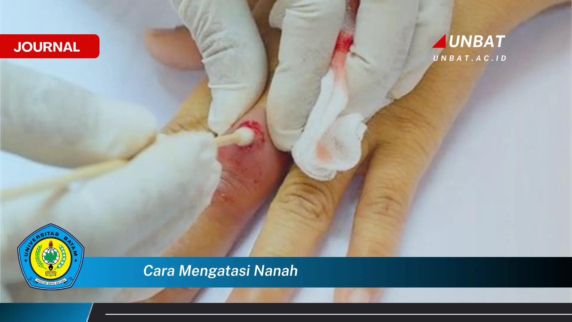 Ketahui Cara Mengatasi Nanah dengan Efektif dan Aman