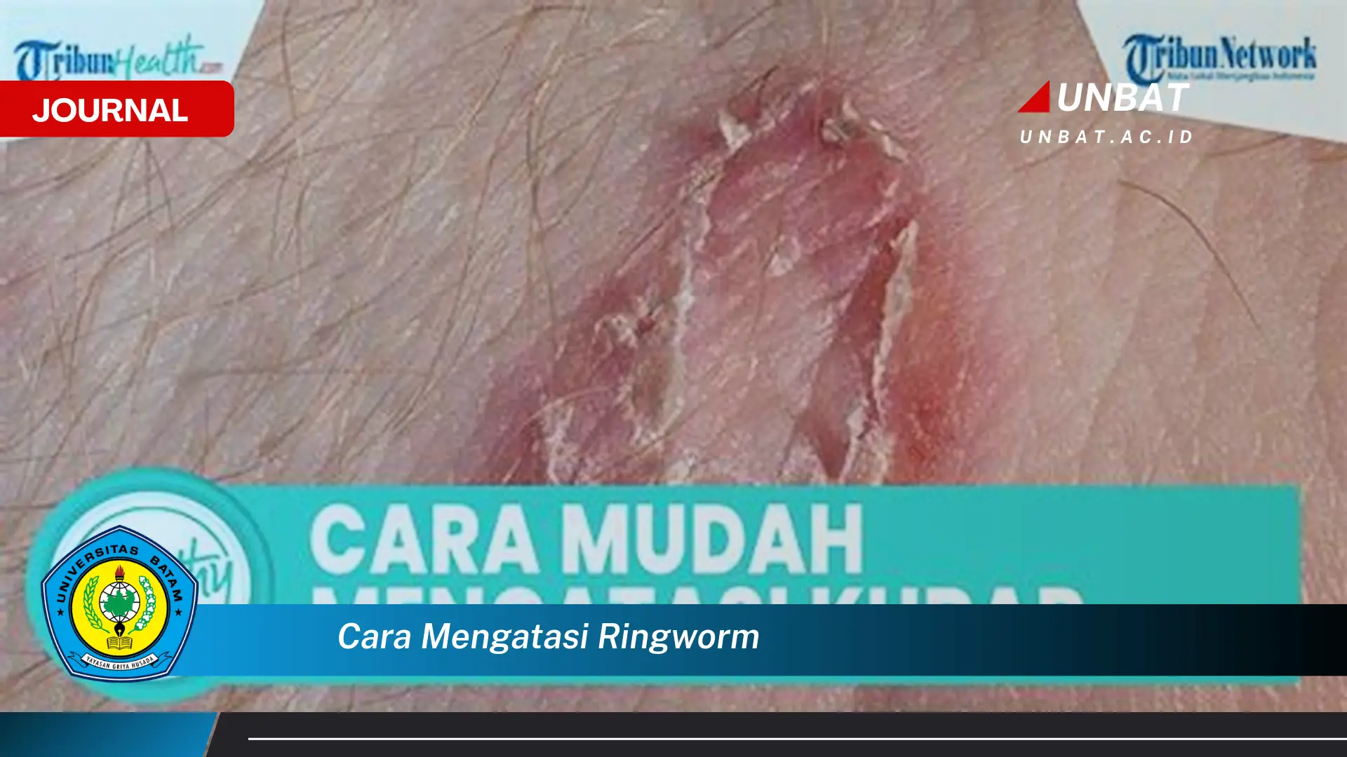 Ketahui Cara Mengatasi Ringworm dengan Cepat dan Ampuh