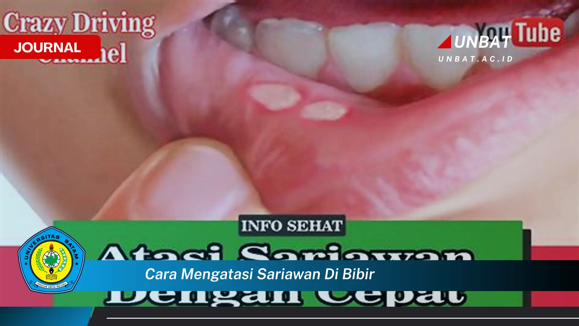 Ketahui Cara Mengatasi Sariawan di Bibir dengan Cepat dan Ampuh