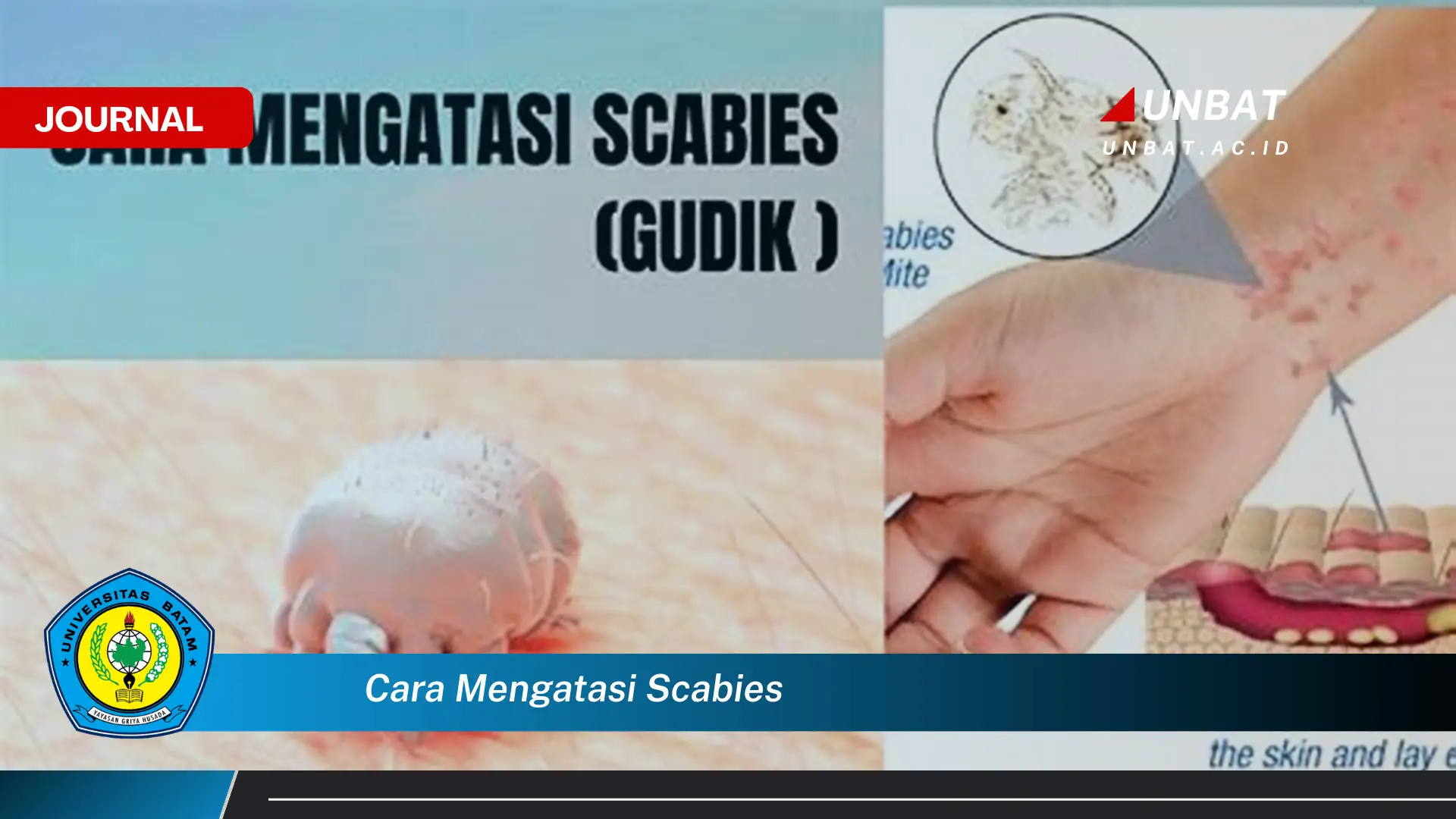 Ketahui Cara Mengatasi Scabies dengan Cepat dan Efektif Ketahui Cara Mengatasi Scabies dengan Cepat dan Efektif