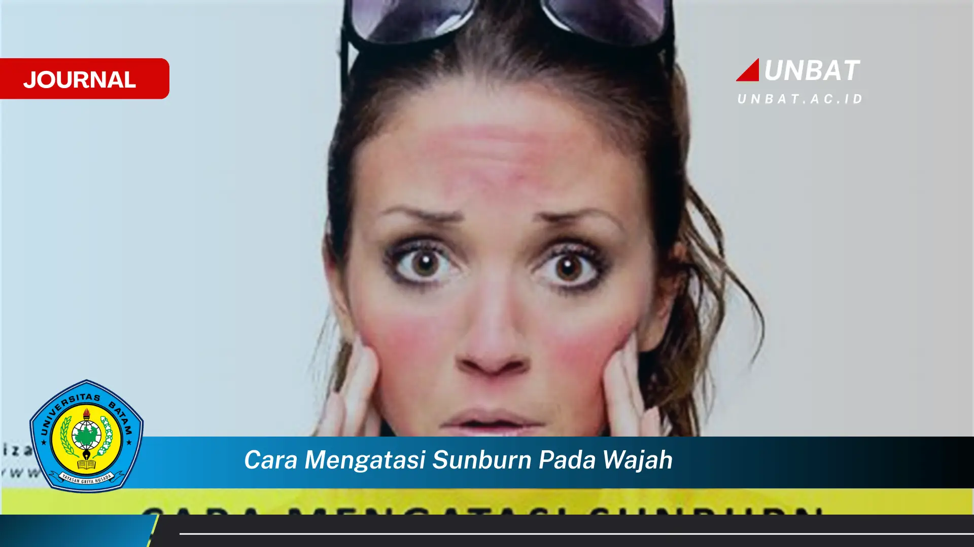 Ketahui Cara Mengatasi Sunburn Pada Wajah Dengan Cepat dan Efektif