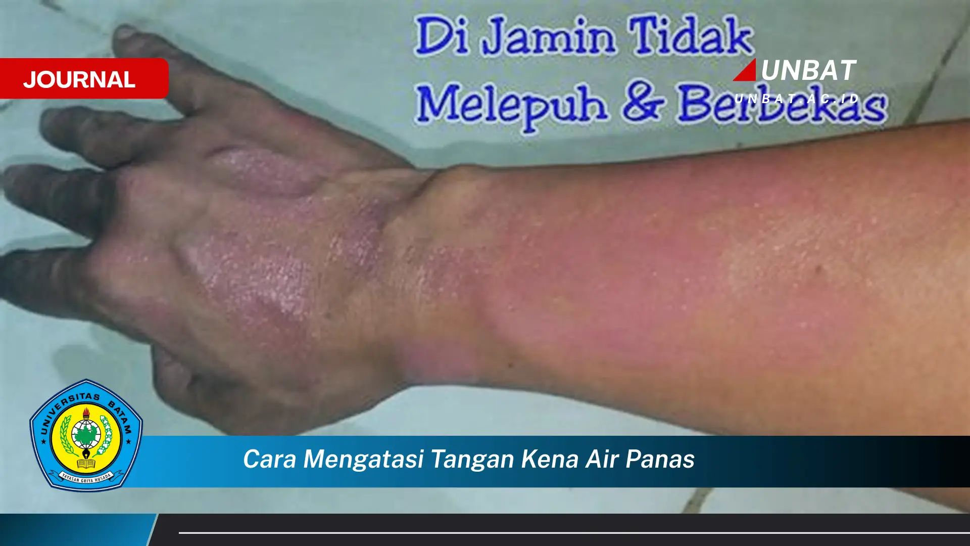 Ketahui Cara Mengatasi Tangan Kena Air Panas, Pertolongan Pertama yang Tepat dan Efektif Ketahui Cara Mengatasi Tangan Kena Air Panas, Pertolongan Pertama yang Tepat dan Efektif