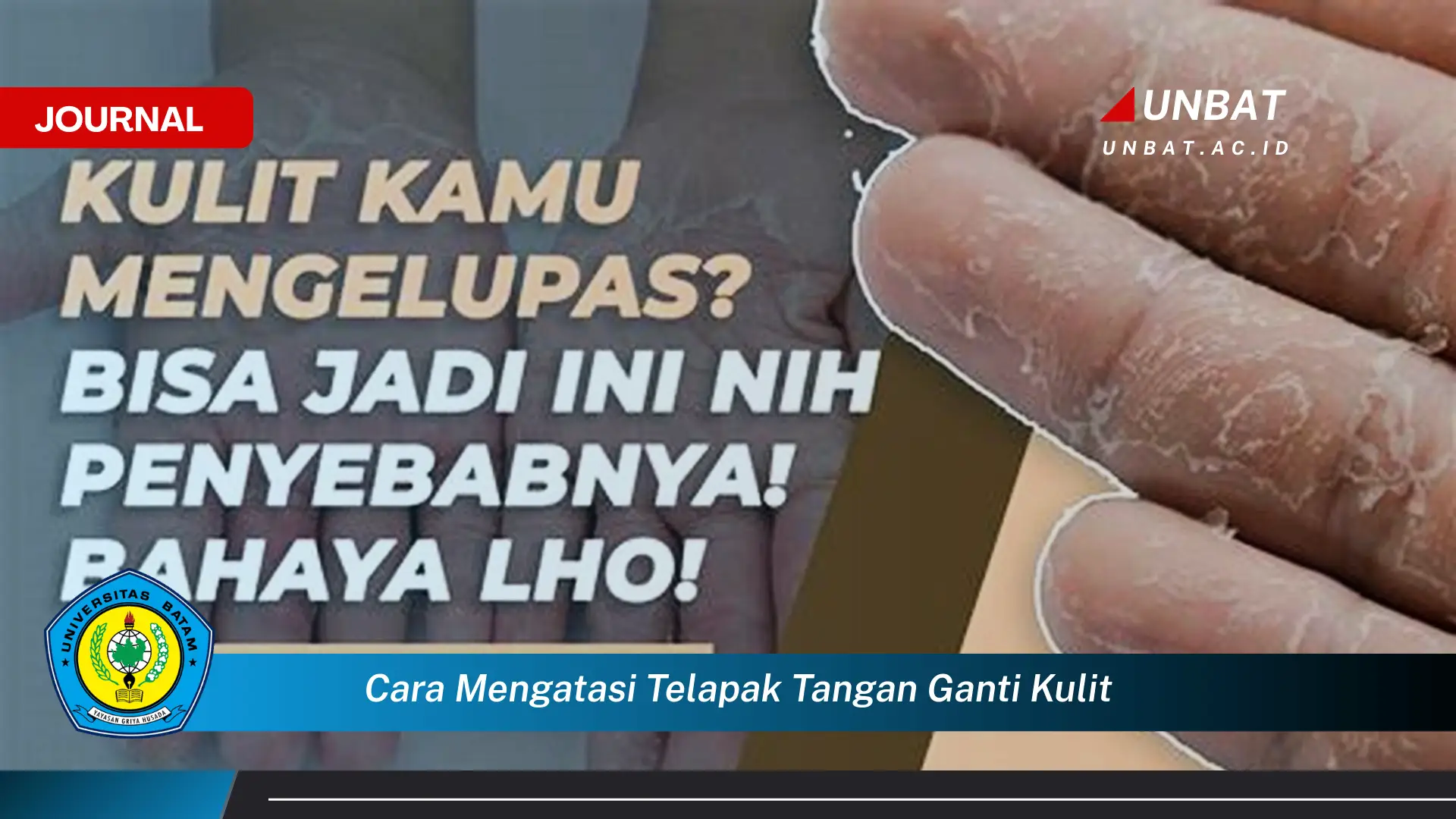 Ketahui Cara Mengatasi Telapak Tangan Ganti Kulit Secara Efektif dan Alami