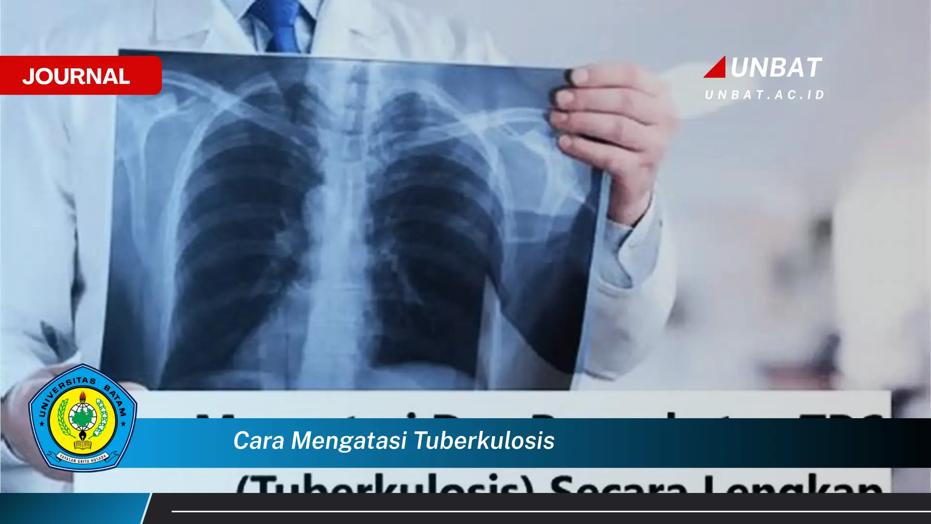 Ketahui Cara Mengatasi Tuberkulosis dan Sembuh Secara Total